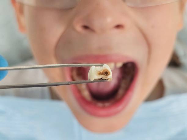 Dentist for Dental Trauma in CO